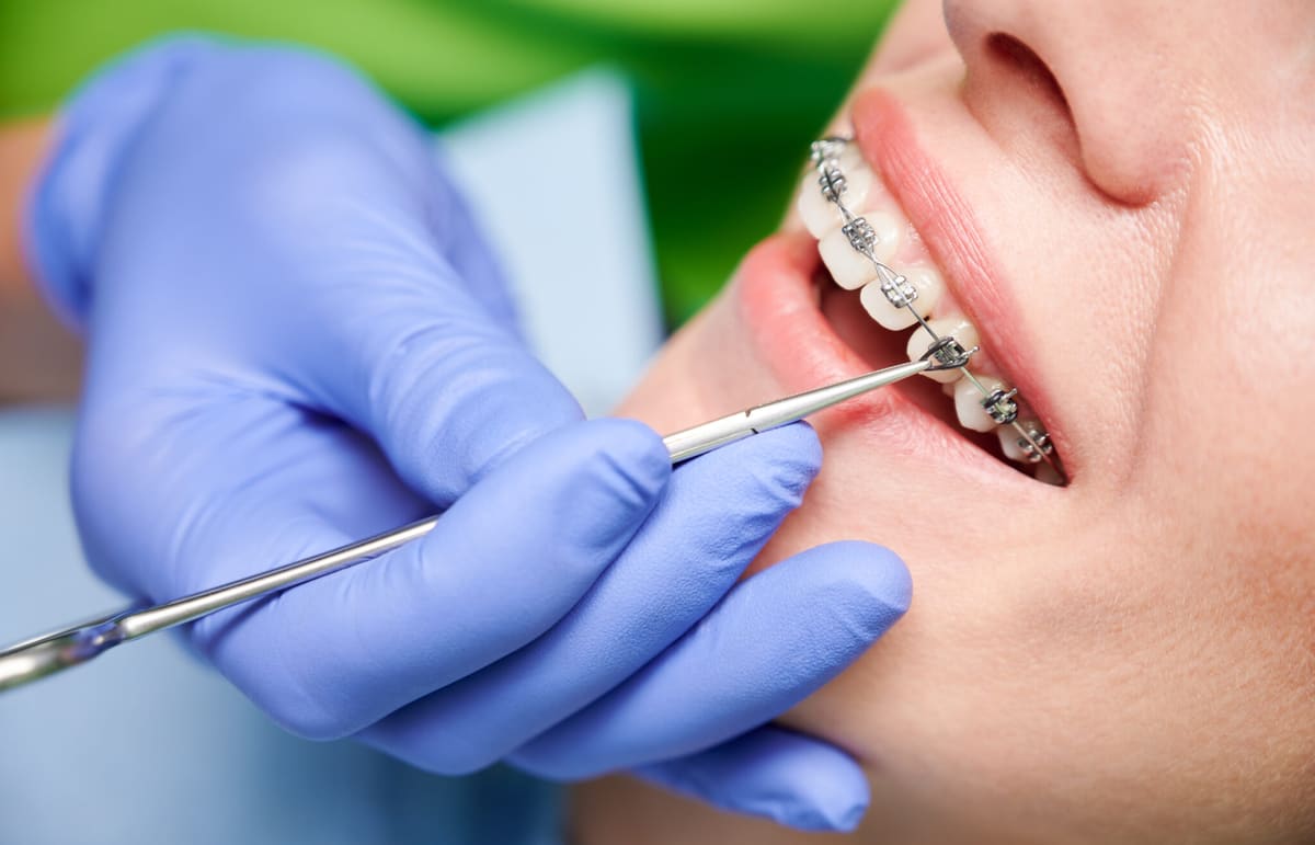 Teeth Braces Treatment in Indore - Bhardwaj Dental Clinic