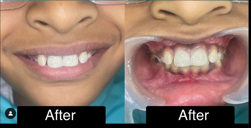 After treatment