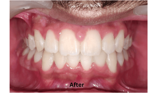 After treatment