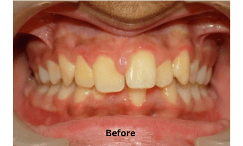 Before treatment